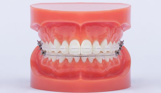 [:hu]Felső Signature III. készülék, leplezett ívvel, alsó Signature III. készülék fém ívvel[:en]Signature III aesthetic ceramic brackets, with aesthetic wire on the upper jaw, and normal metal wire on the lower jaw[:de]Signature III ästhetische Keramik-Brackets[:]