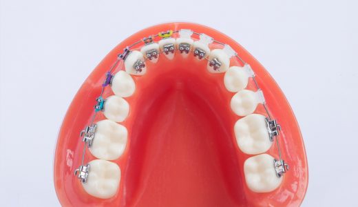 [:hu]Belső fogszabályozó iTTR[:en]i-TTR metal bracket “Internal orthodontics”[:de]i-TTR Metallklammer “Interne Zahnregulierung”[:]