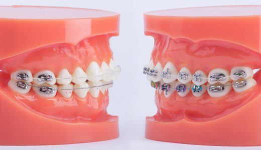 [:hu]Esztétikus és fém megoldások összehasonlítása János nevű mulázsomon[:en]Comparing aesthetic and metal orthodonic systems[:de]Vergleichen ästhetische Systeme und Metall KFO[:]