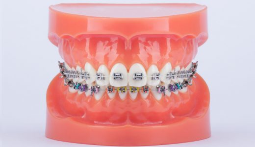 [:hu]Sapphire fém fogszabályozó rendszer[:en]Modern Orthodontics Sapphire Metall-Brackets[:de]Modern Orthodontics Sapphire Metall-Brackets[:]